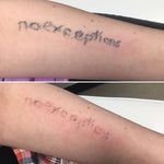 Laser tattoo Removal