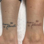 Laser Tattoo Removal