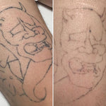 Laser Tattoo Removal