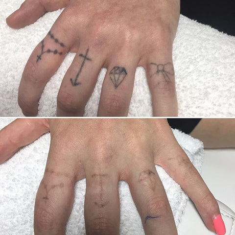 Laser Tattoo Removal