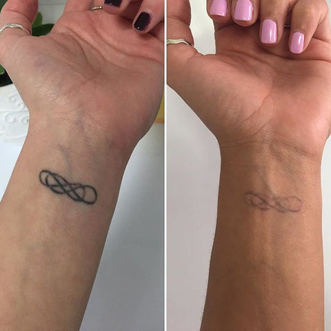 Laser Tattoo Removal