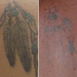 Laser Tattoo Removal